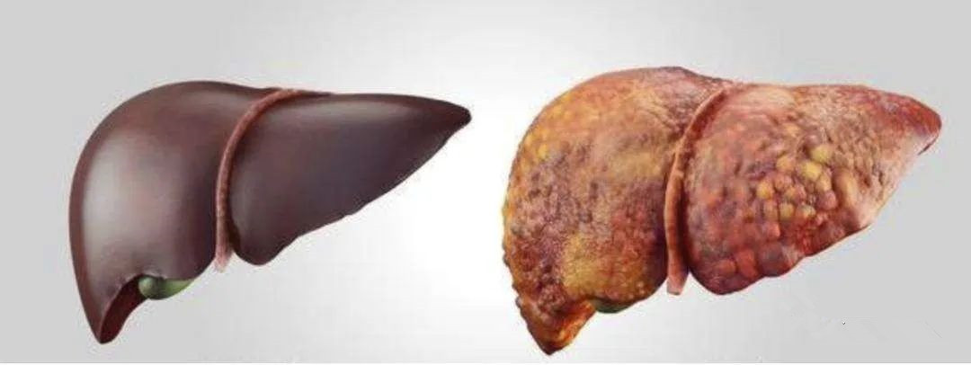 干细胞治疗肝硬化费用,用干细胞治疗肝硬化最好的医院