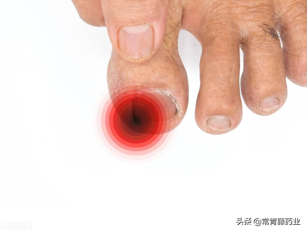 甲沟炎的痛苦程度,甲沟炎折磨人