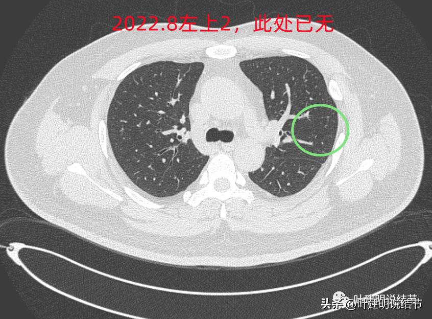 如何判断肺磨玻璃结节是高危结节,肺上有混合磨玻璃结节要注意什么