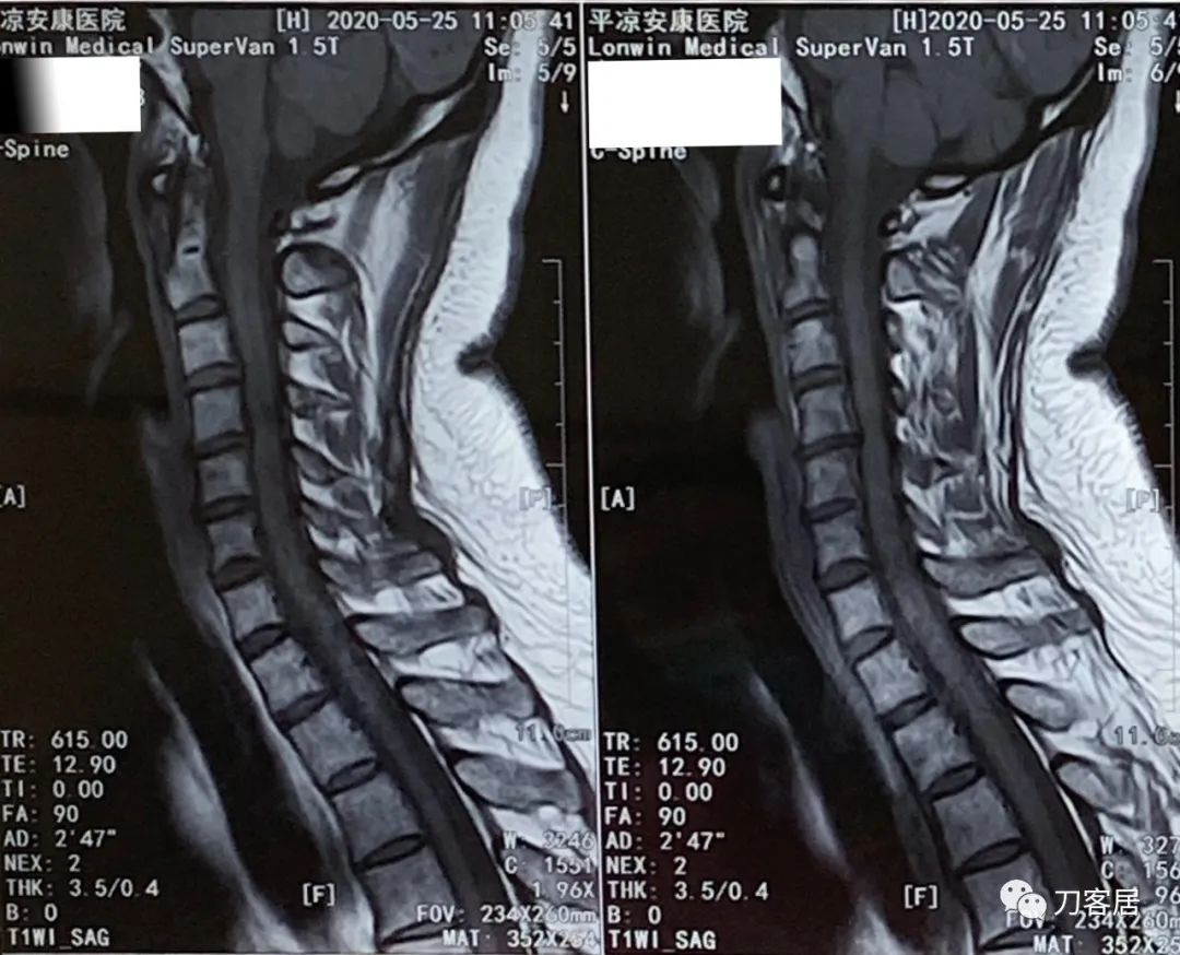 颈椎病十年了手臂酸痛肩背痛,颈椎病十年了一直痛怎么办