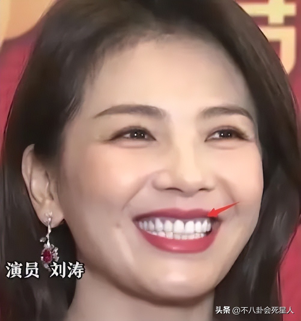 烤瓷牙有多恐怖,烤瓷牙害我一生