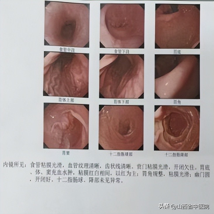 食管轻度不典型增生怎么治疗,食道非典型增生可以自愈吗