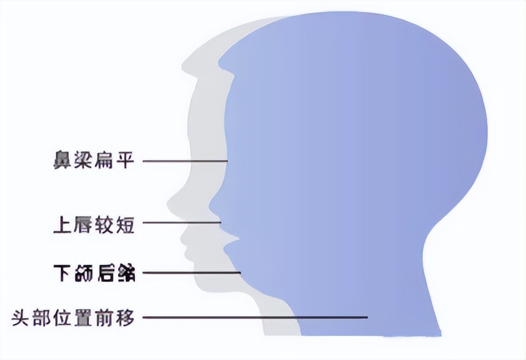 如何干预口呼吸,预防口呼吸应该注意什么