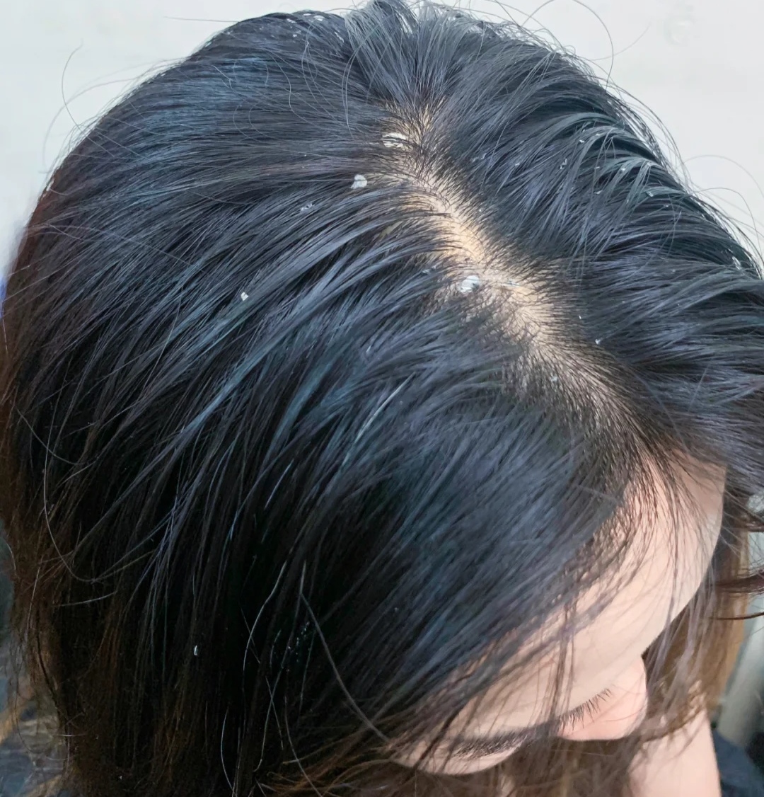 干性头皮屑去屑洗发水哪种最好,顽固性头屑用哪一款洗发水比较好