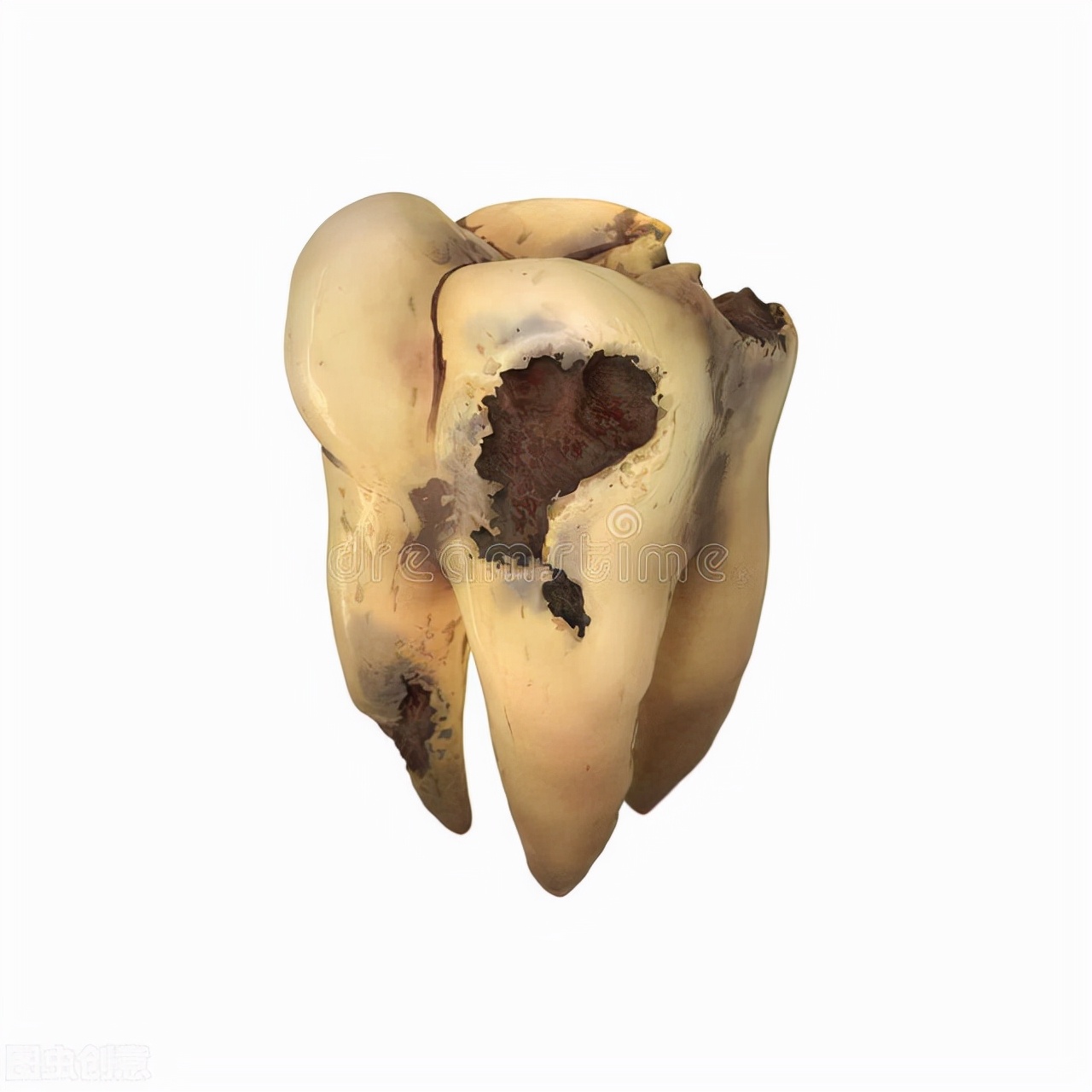 蛀牙疼痛怎么办最快止痛最有效,如何快速缓解蛀牙疼