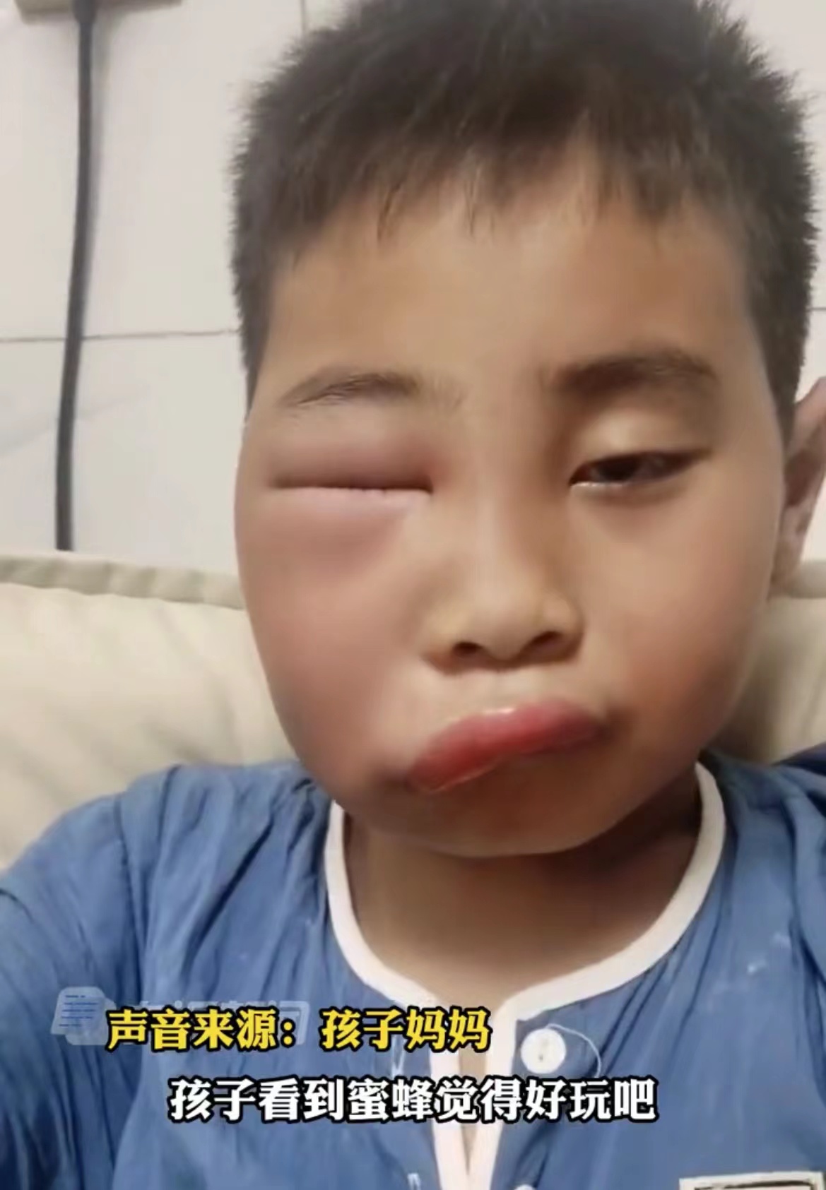 喜提完整童年！男孩好奇捅蜂窝被蜜蜂蛰，网友：亲妈都不认识他了