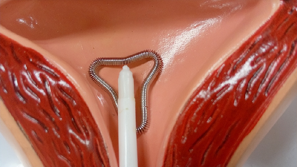 节育环一直不取会怎么样,节育环20多年尾丝会长在肉里面吗