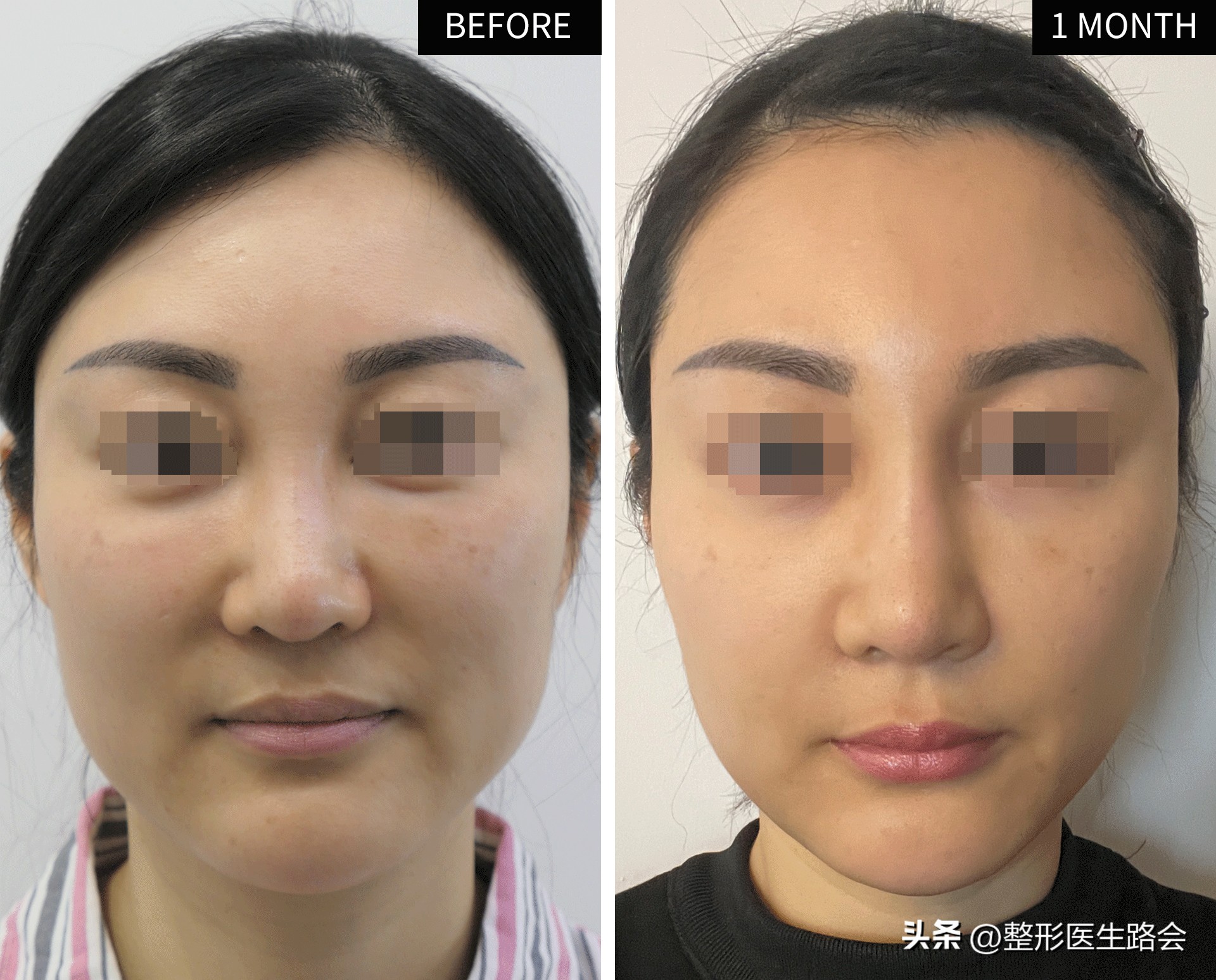 做鼻基底填充消除法令纹有风险吗,鼻基底填充能消除法令纹吗