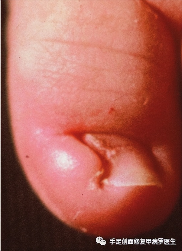 宝宝脚趾甲有脓了怎么处理,给宝宝剪指甲流脓怎么办