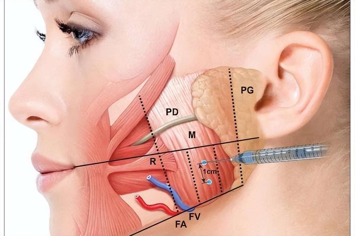 应采儿打瘦脸针,应采儿瘦脸针