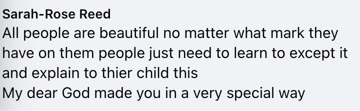 美国小女孩脸带“蝙蝠侠”黑印,治疗两年经过终于恢复肉色!