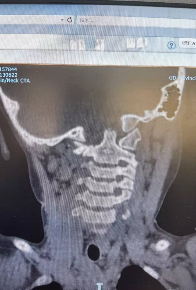 儿童落枕最快恢复办法,落枕了30秒自愈方法儿童