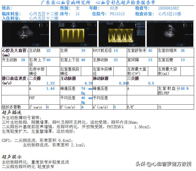 主动脉瓣狭窄的典型三联征表现,主动脉瓣狭窄治疗新技术