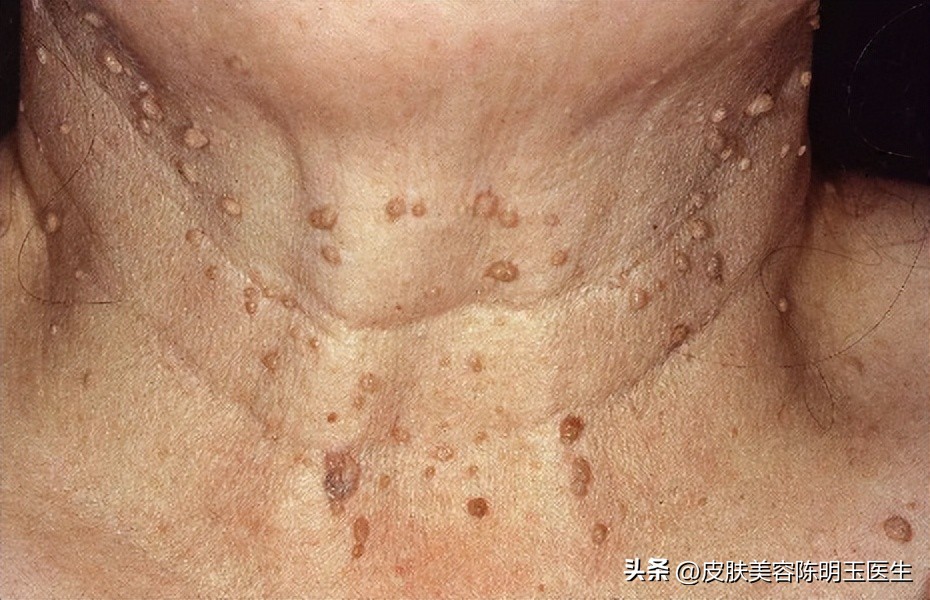 50岁男人脖子上长小肉粒怎么回事,脖子长了一些小肉粒是什么问题
