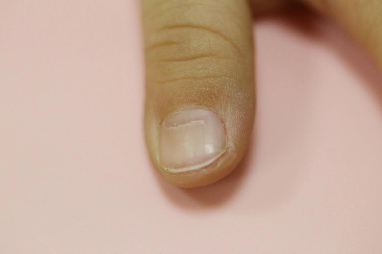 指甲出现异常是肝上出问题了吗,口苦口臭指甲竖纹是肝的问题吗