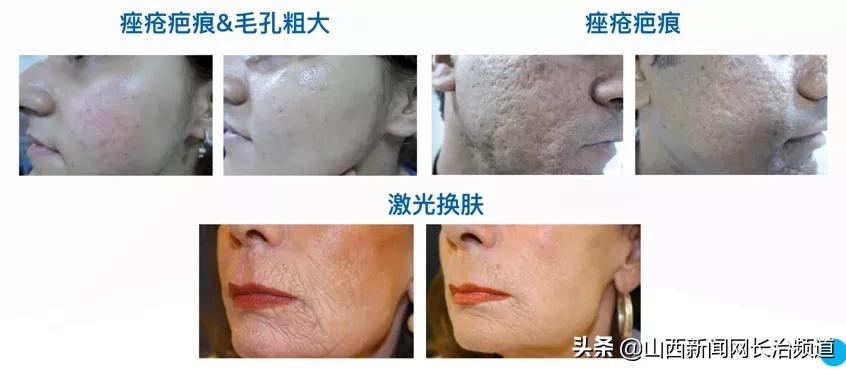 长治哪家医院治痘坑效果好,长治治疗痘坑最好的医院