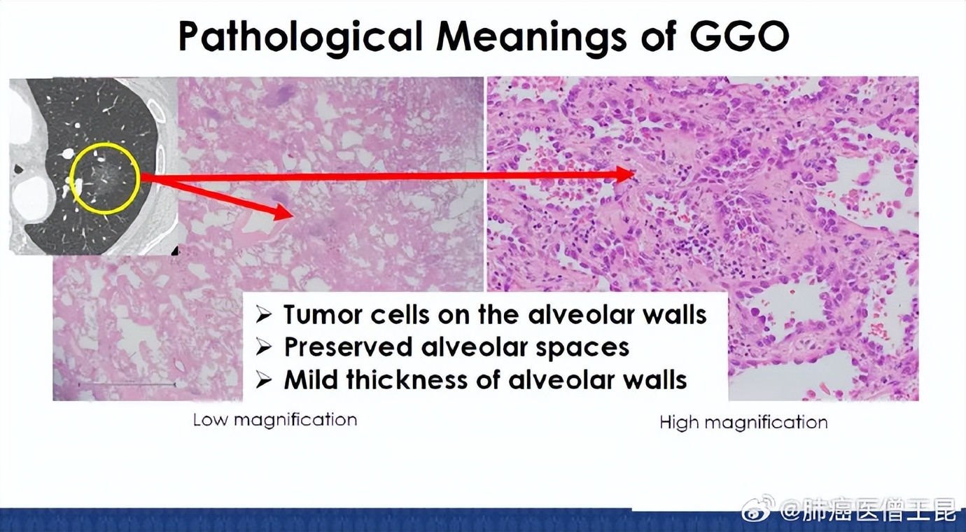 肺磨玻璃结节(GGO)最佳处理策略——东西方观点