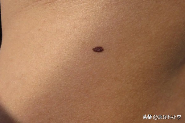 身上出现不痒的小红点是怎么回事,身上突然起了很多小红点不痛不痒