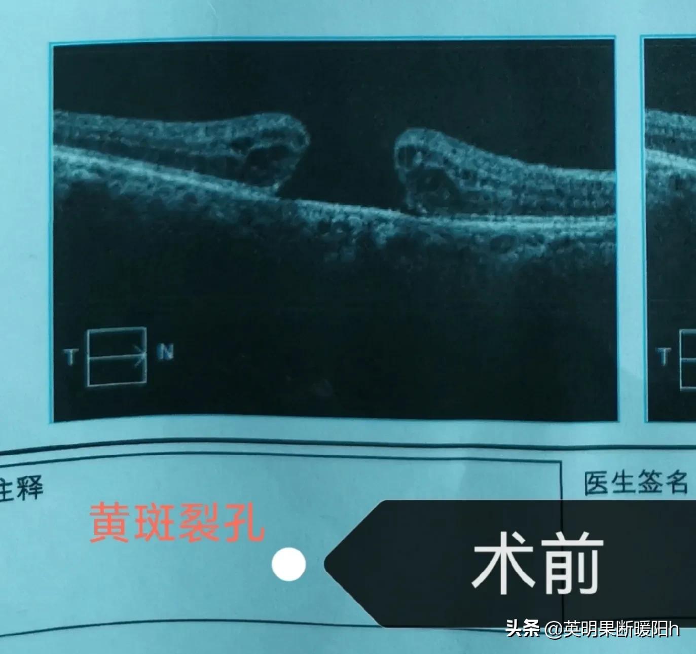 眼睛黄斑裂孔中医能治好吗怎么治,眼睛黄斑裂孔有什么症状