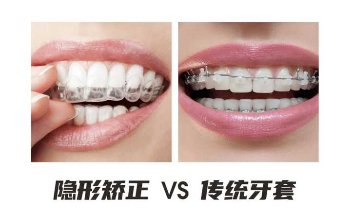 隐适美牙套脸型变化,戴隐适美牙套