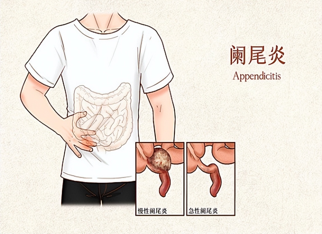 阑尾炎症状表现有哪些要做手术吗,阑尾炎的位置症状表现和治疗方法