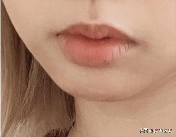 假玻尿酸毁容案例,玻尿酸注射如何避免网红脸