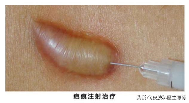 手术后疤痕好明显怎么办,怎样消除手术后留下的疤痕