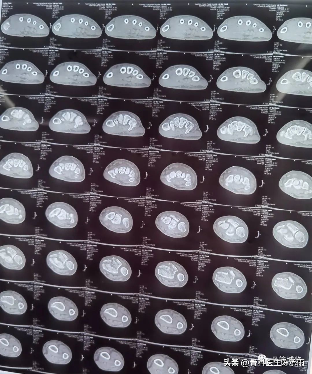 桡骨远端骨折伸直型的复位及固定,掌骨骨折外固定支架恢复