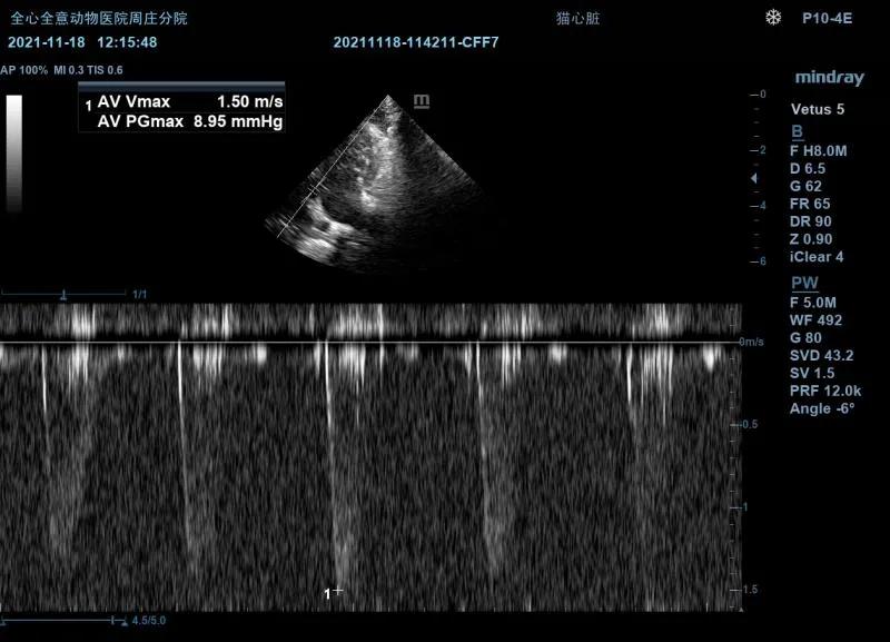 二尖瓣发育不良病例总结