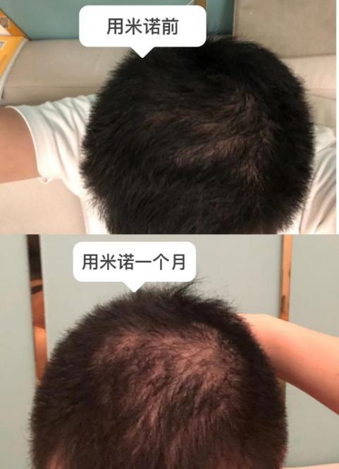 米诺地尔智商税 (米诺地尔20%是智商税吗)