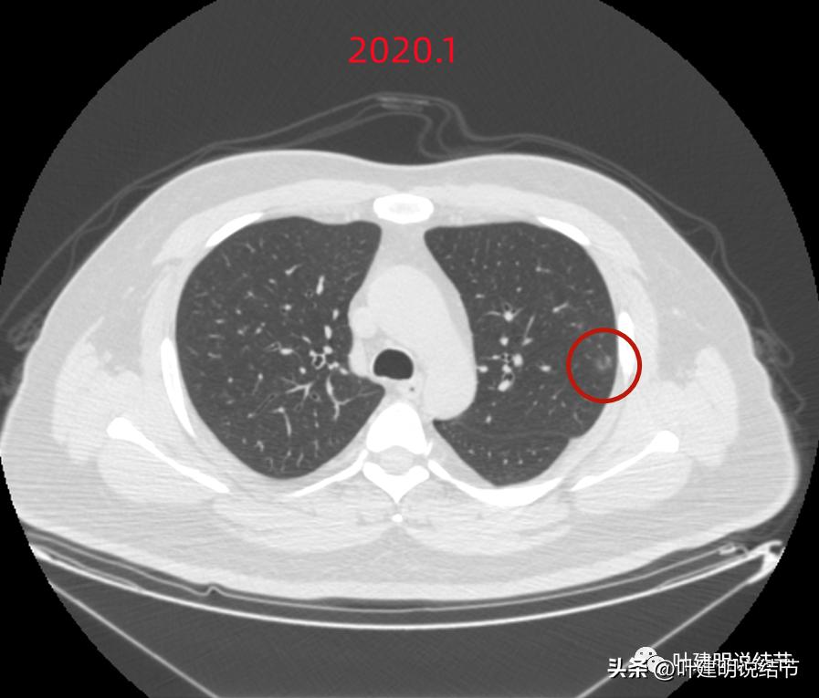如何判断肺磨玻璃结节是高危结节,肺上有混合磨玻璃结节要注意什么
