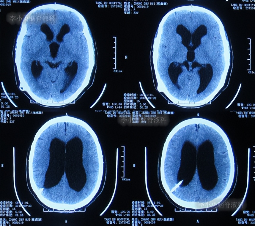 脑积水手术后4天还呕吐怎么回事,脑积水分流术后一直腹部疼痛