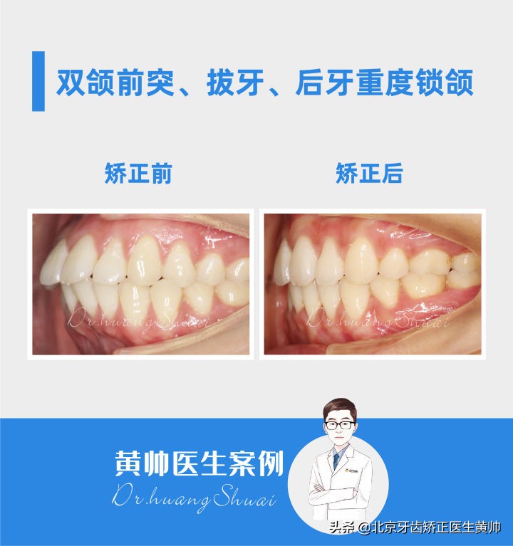 嘴凸的人怎么笑起来好看,嘴型比较凸的人怎么改善