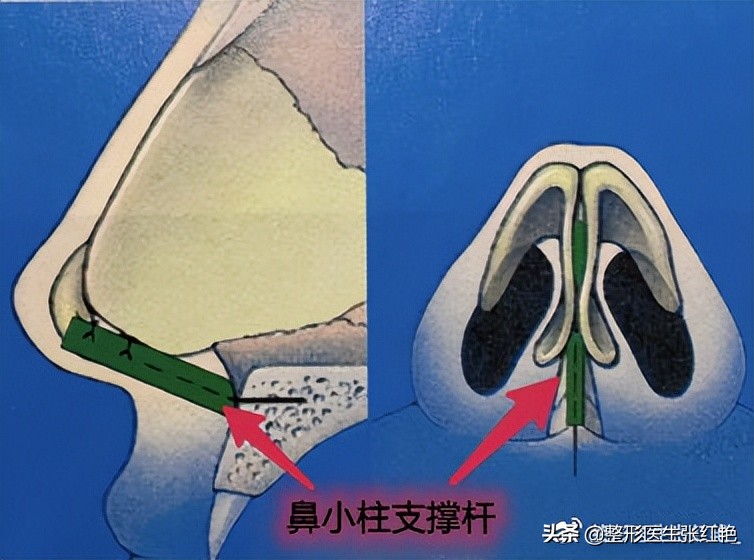 塌鼻头大鼻头怎么修容,塌鼻子和大鼻头如何变高挺