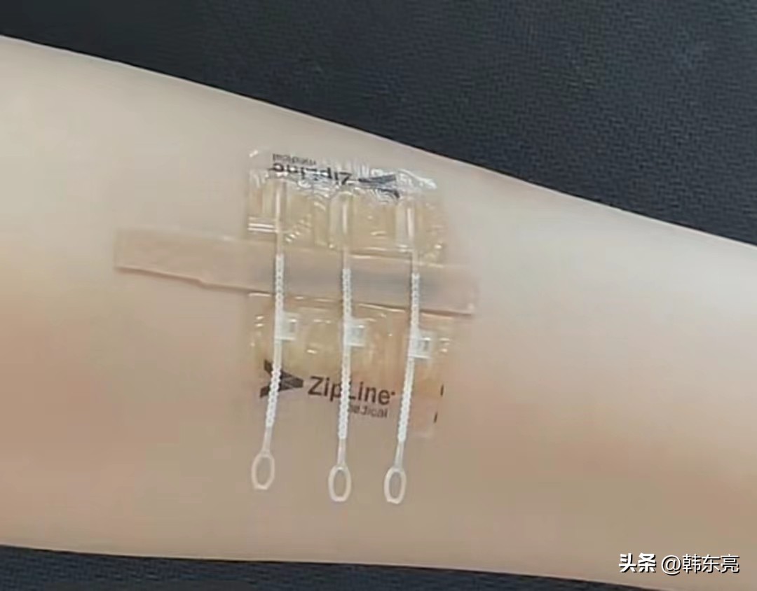 疤痕贴和减张器哪个好,疤痕减张器贴错了