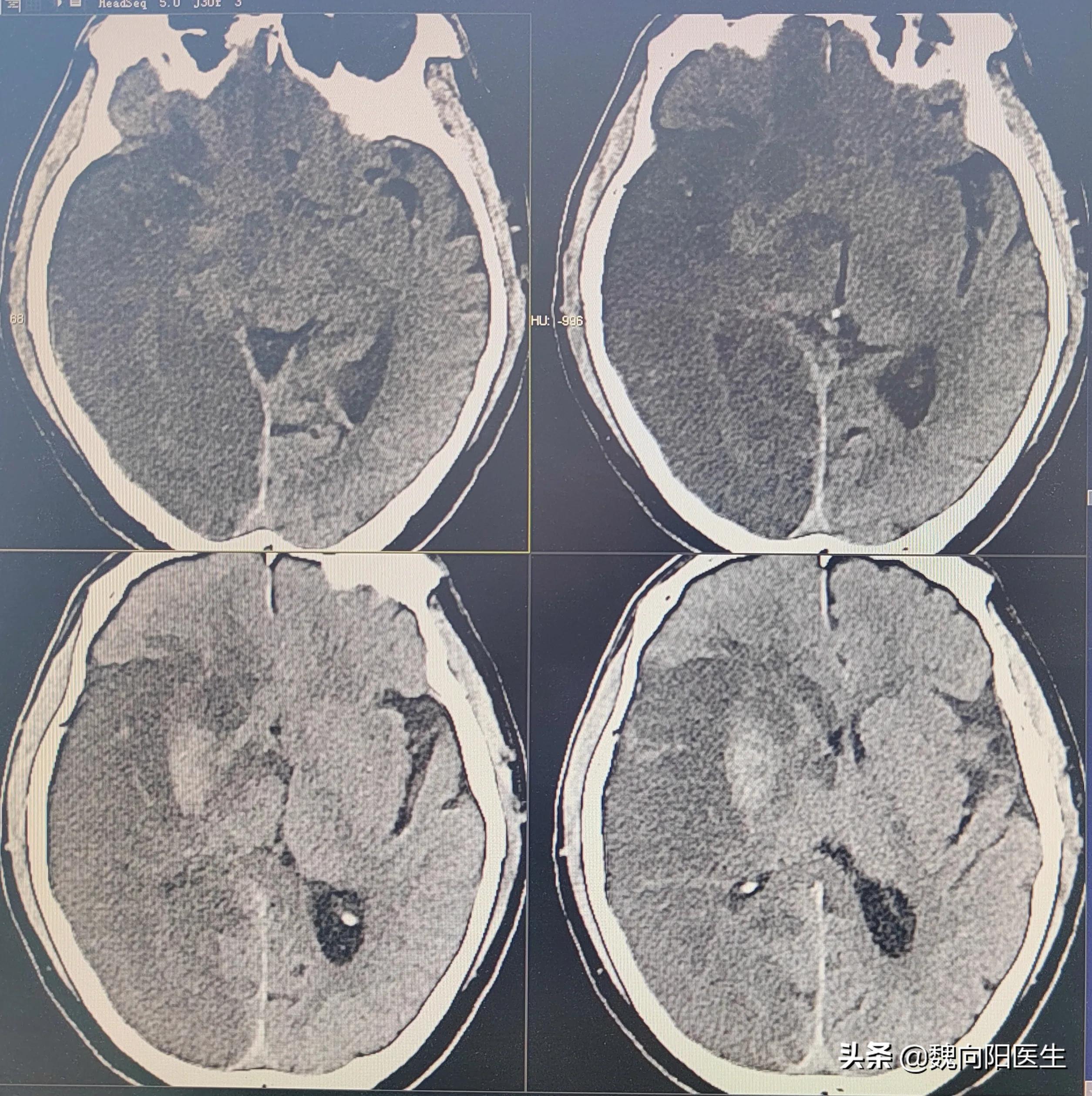 脑出血病人急救黄金30秒,脑血栓免费康复训练