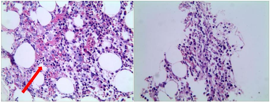非肝硬化门脉高压是怎么回事,黑热病为什么会导致肝脾肿大