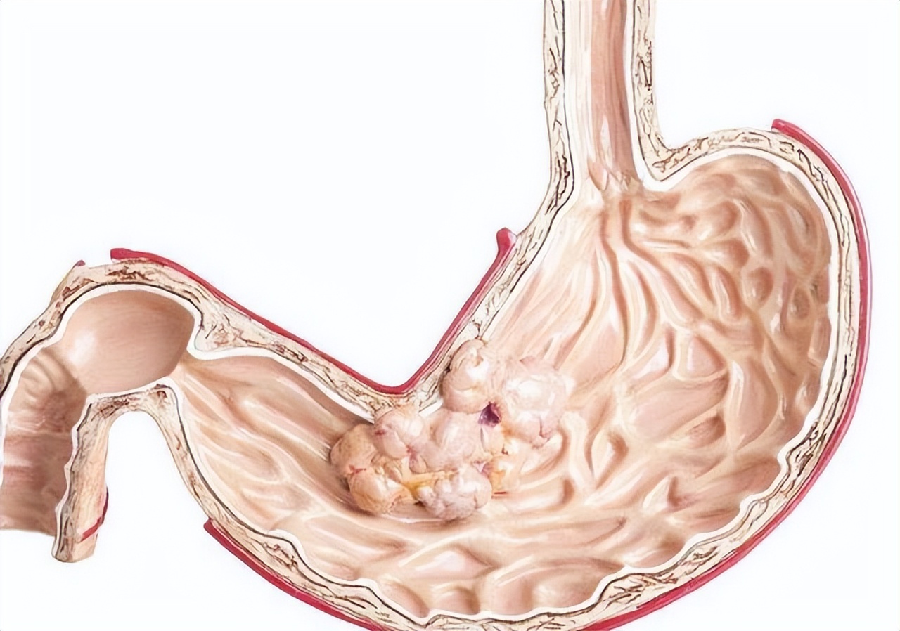 胃镜间隔多久做一次合适,胃镜多久做一次对身体有伤害吗