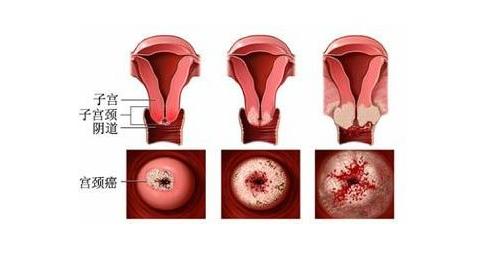 宫颈癌治疗期间，“阴道冲洗”必不可少，且有讲究