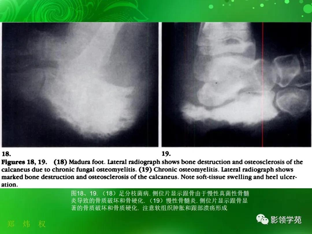 正常跟骨影像图,跟骨正常与变异影像表现图片