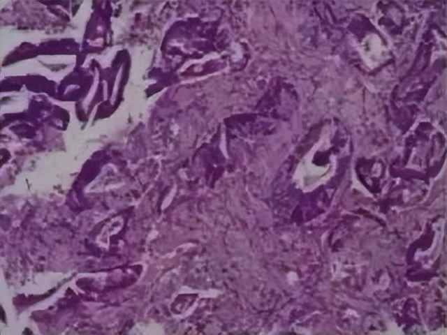 多原发癌症转移,多原发直肠癌