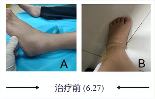 崴脚、富贵包、腰痛这些都可以去一个科一针搞定