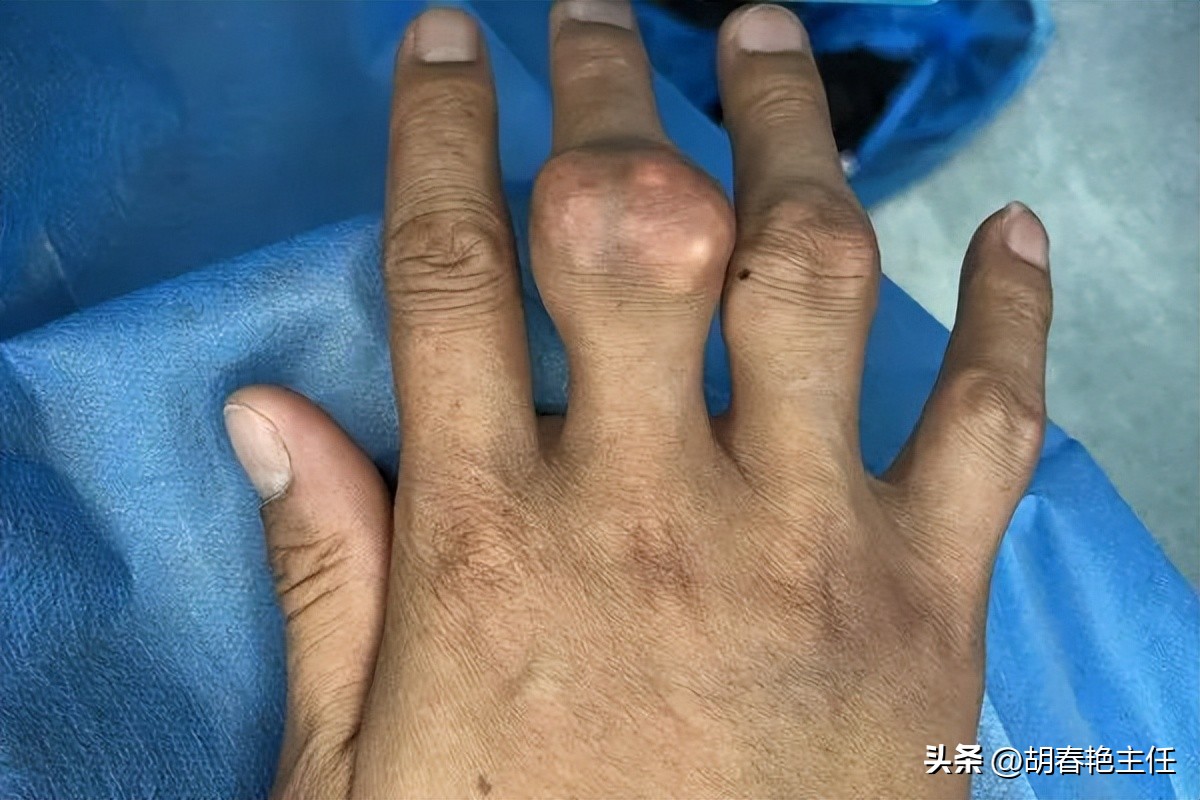 痛风石可以吃药溶解吗,怎样溶解痛风石