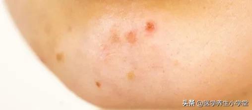 脸上总是长痘痘怎么办？反复发作用药也不好，1个办法彻底解决它