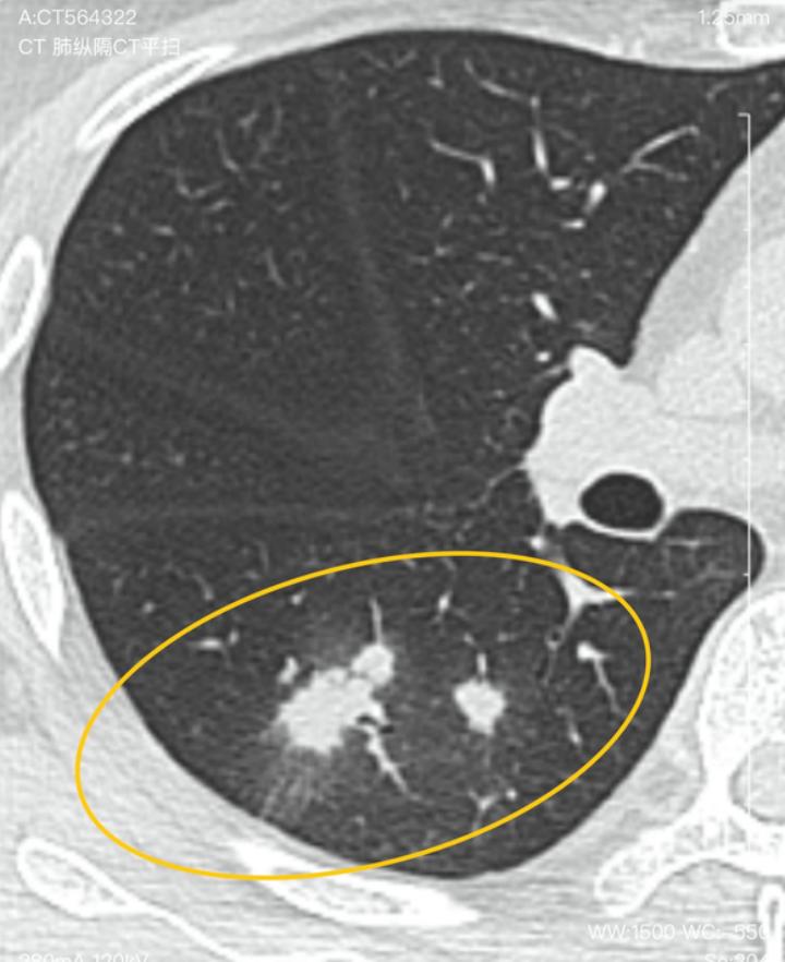 8mm肺结节一般几年转癌,8mm肺结节一年后没了严重吗