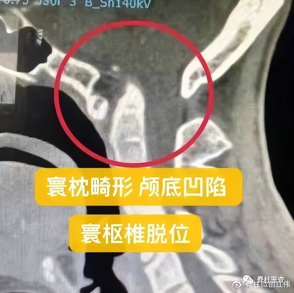 颅底凹陷症齿状突半脱位,颅底手术新突破