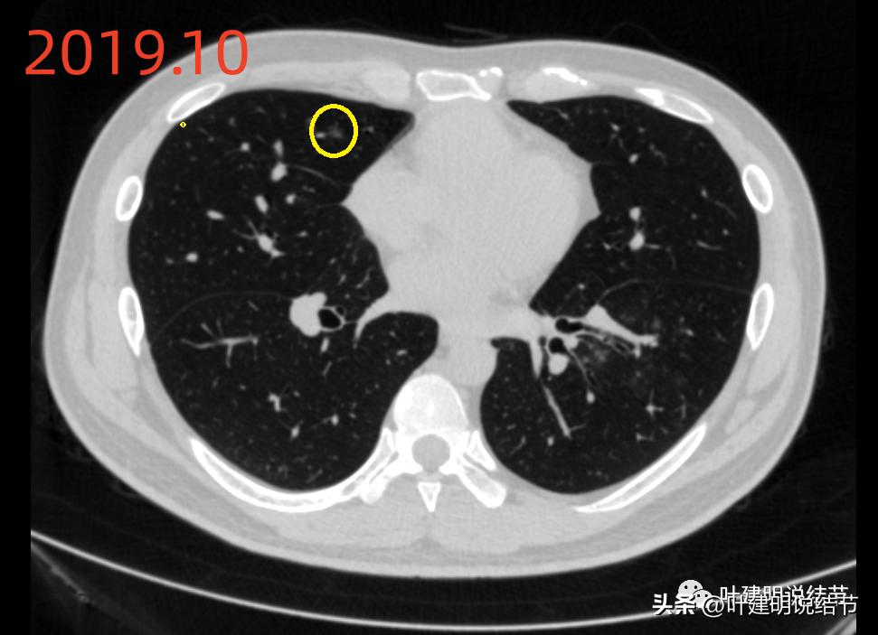 肺炎好了磨玻璃结节还存在,球形肺炎治愈后肺部留有结节