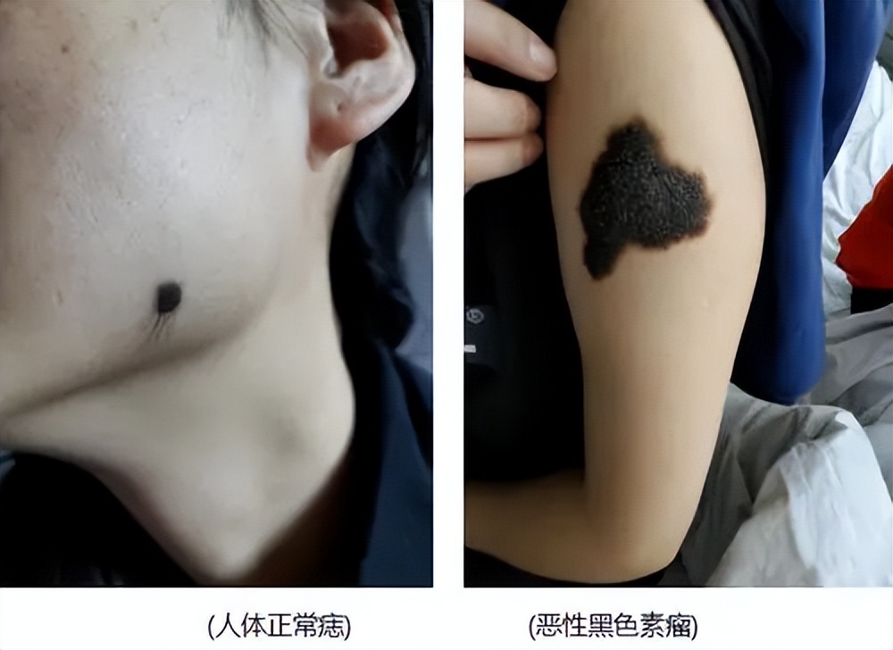 脚后跟长鸡眼严重性,脚后跟有个三四年的鸡眼