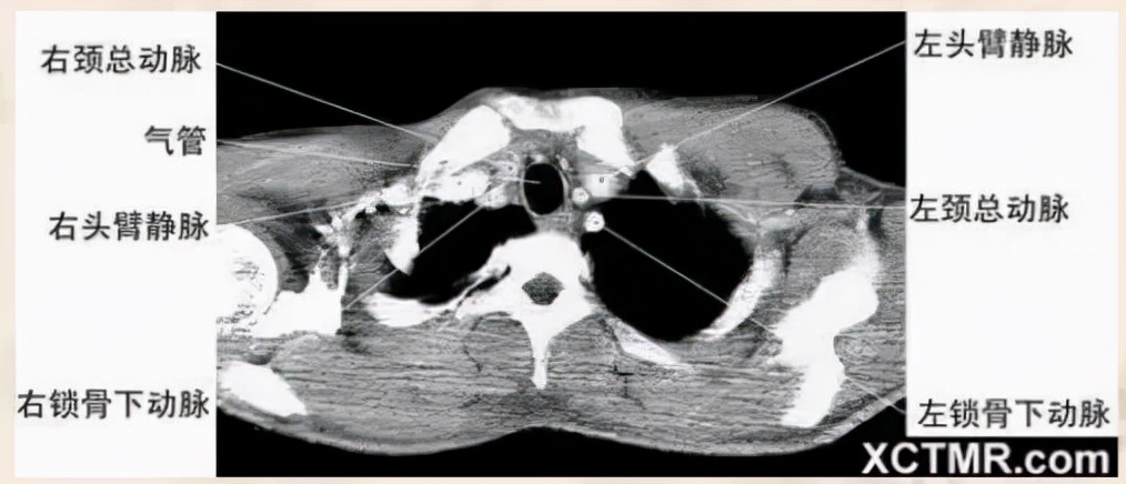 胸腹部盆腔ct主要检查什么,女性盆腔ct断层解剖结构图