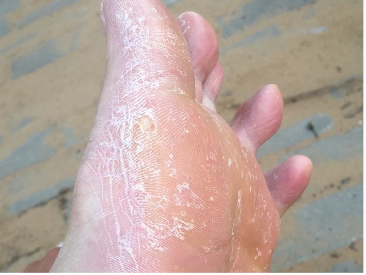 鳞屑角化型脚气足光散可以治疗么,鳞屑角化型脚气抹什么药膏效果好